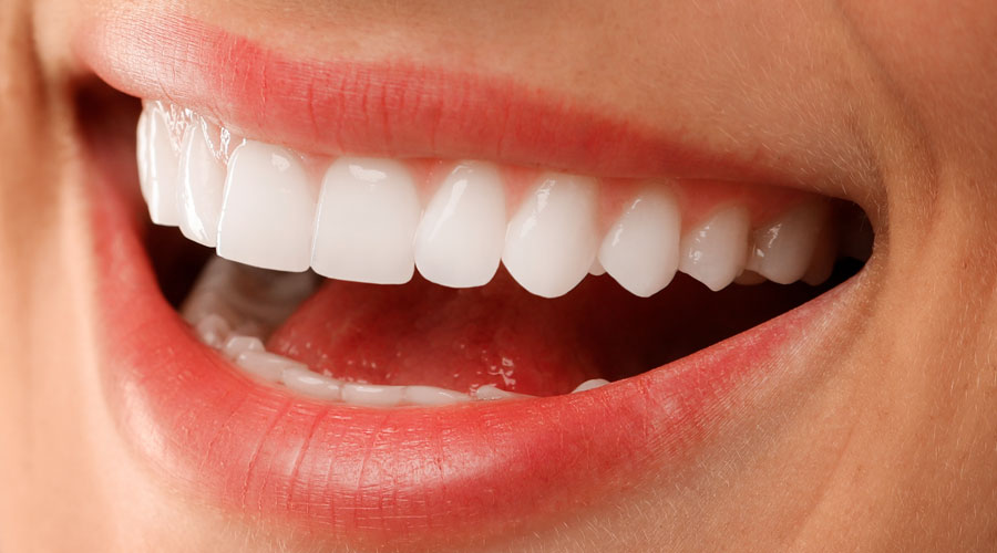 Éclaircissement dentaire