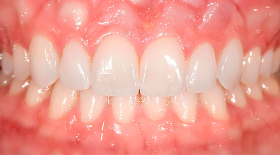 Traitement orthodontique